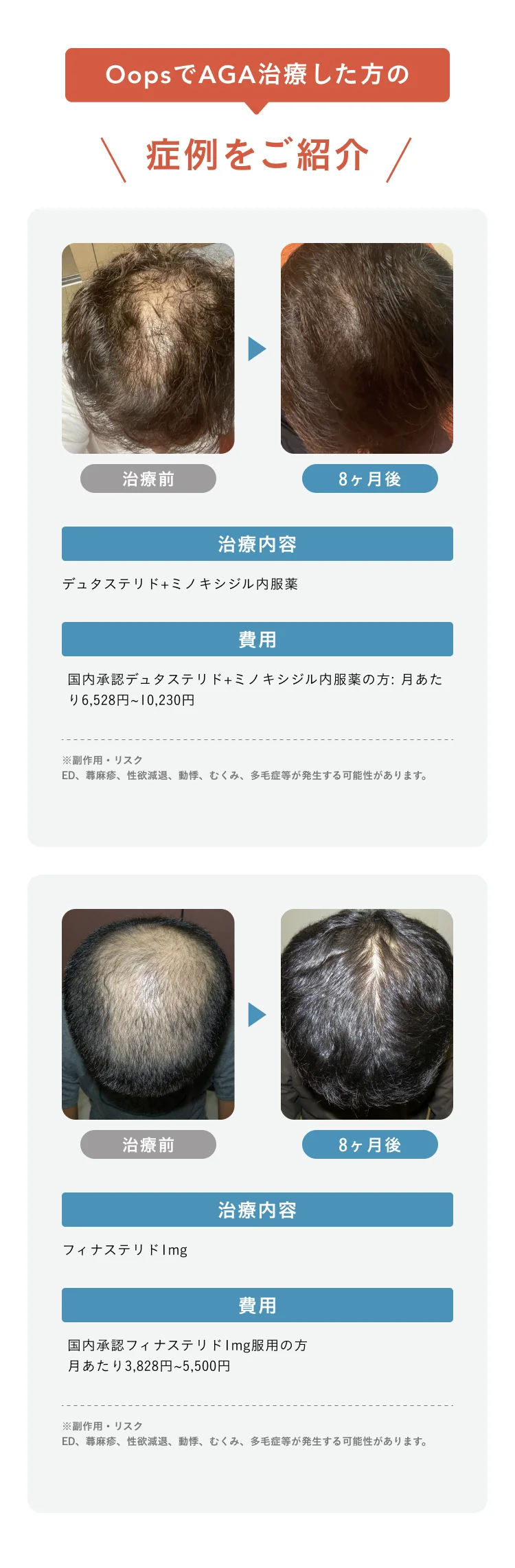 OopsでAGA治療した方の症例をご紹介